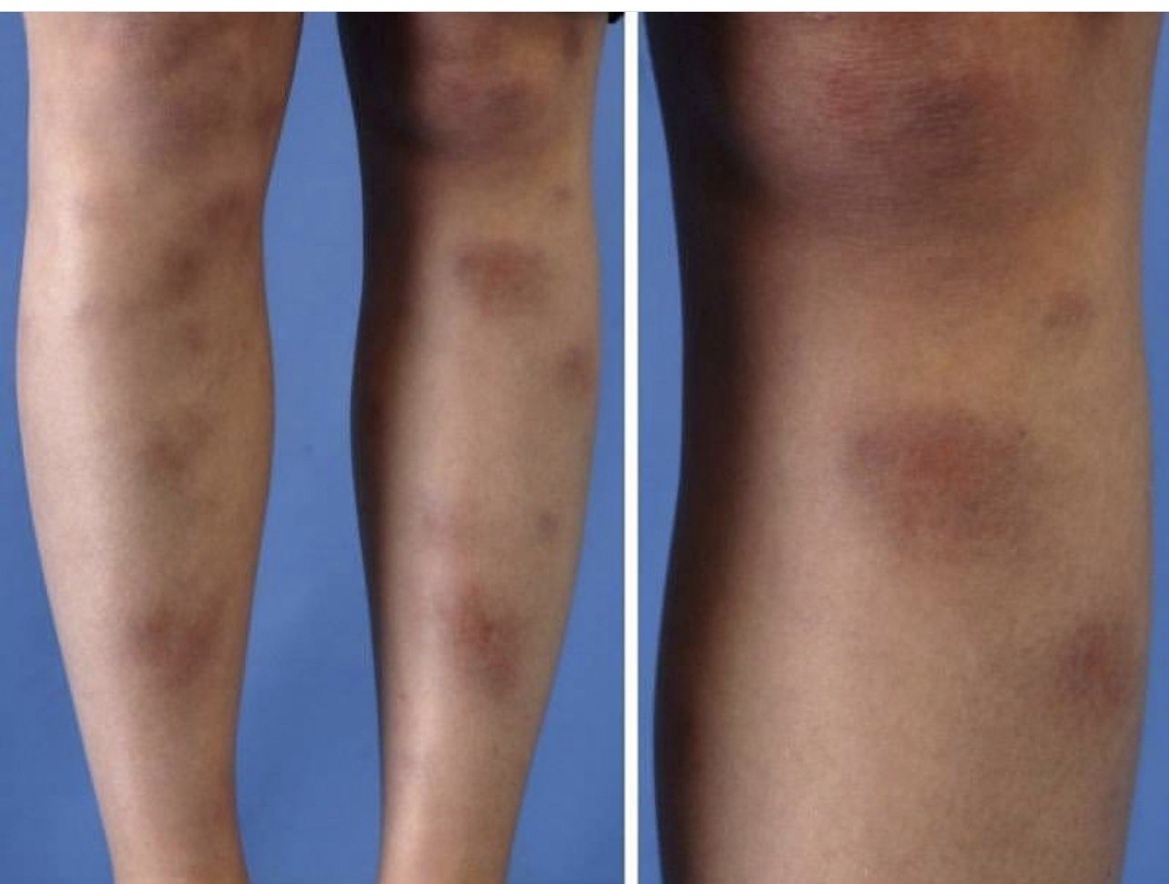 การอักเสบของชั้นไขมันใต้ผิวหนัง Erythema Nodosum คืออะไร ดูแลได้อย่างไร ? การอักเสบของชั้นไขมันใต้ผิวหนัง Erythema Nodosum คืออะไร ดูแลได้อย่างไร ?