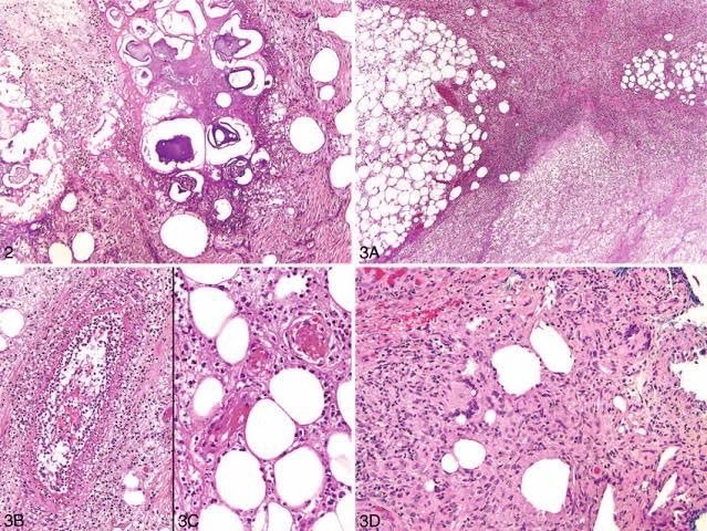การอักเสบของชั้นไขมันใต้ผิวหนัง Erythema Nodosum คืออะไร ดูแลได้อย่างไร ? การอักเสบของชั้นไขมันใต้ผิวหนัง Erythema Nodosum คืออะไร ดูแลได้อย่างไร ?
