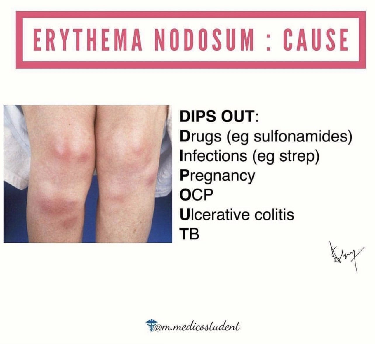 การอักเสบของชั้นไขมันใต้ผิวหนัง Erythema Nodosum คืออะไร ดูแลได้อย่างไร ? การอักเสบของชั้นไขมันใต้ผิวหนัง Erythema Nodosum คืออะไร ดูแลได้อย่างไร ?