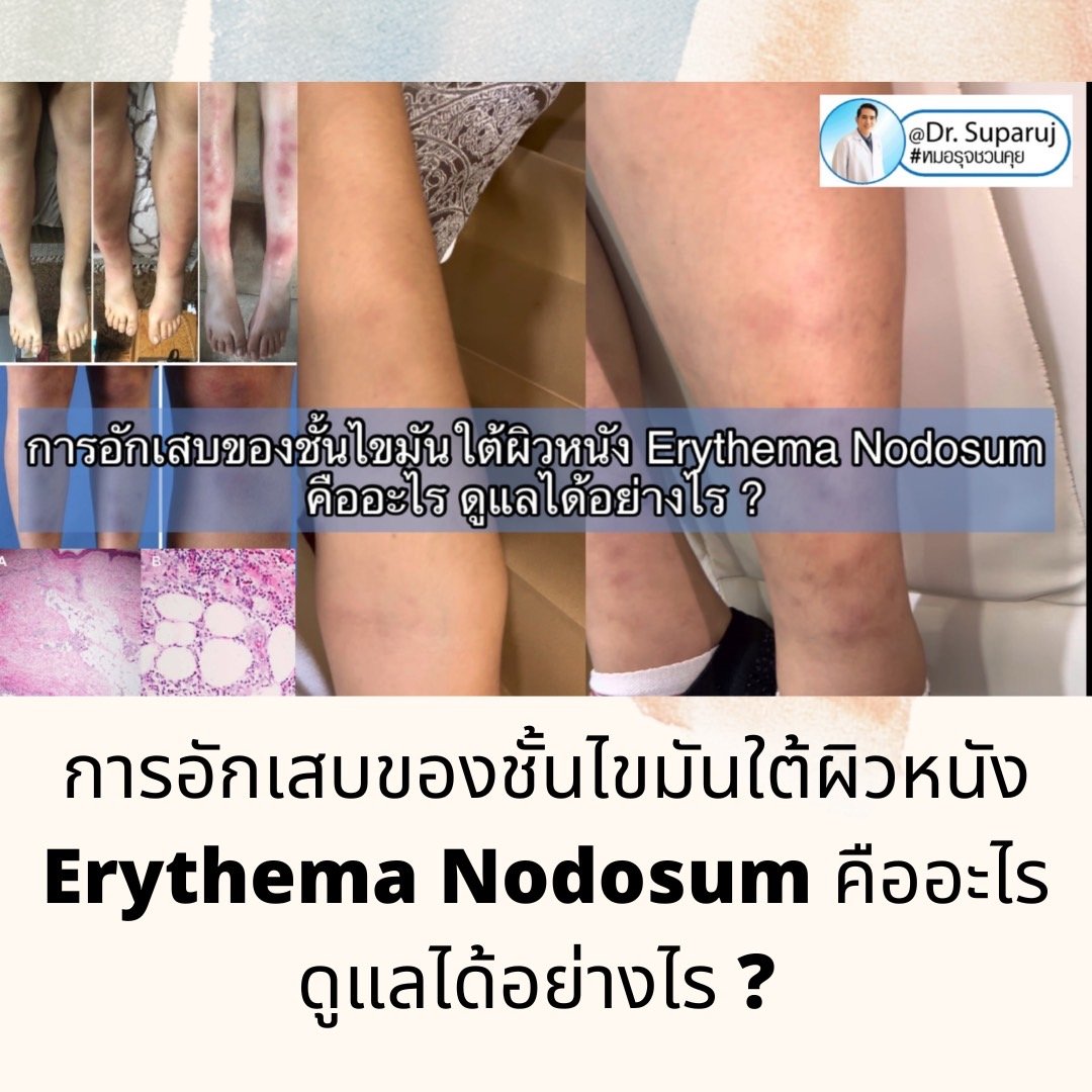 การอักเสบของชั้นไขมันใต้ผิวหนัง Erythema Nodosum คืออะไร ดูแลได้อย่างไร ? การอักเสบของชั้นไขมันใต้ผิวหนัง Erythema Nodosum คืออะไร ดูแลได้อย่างไร ?