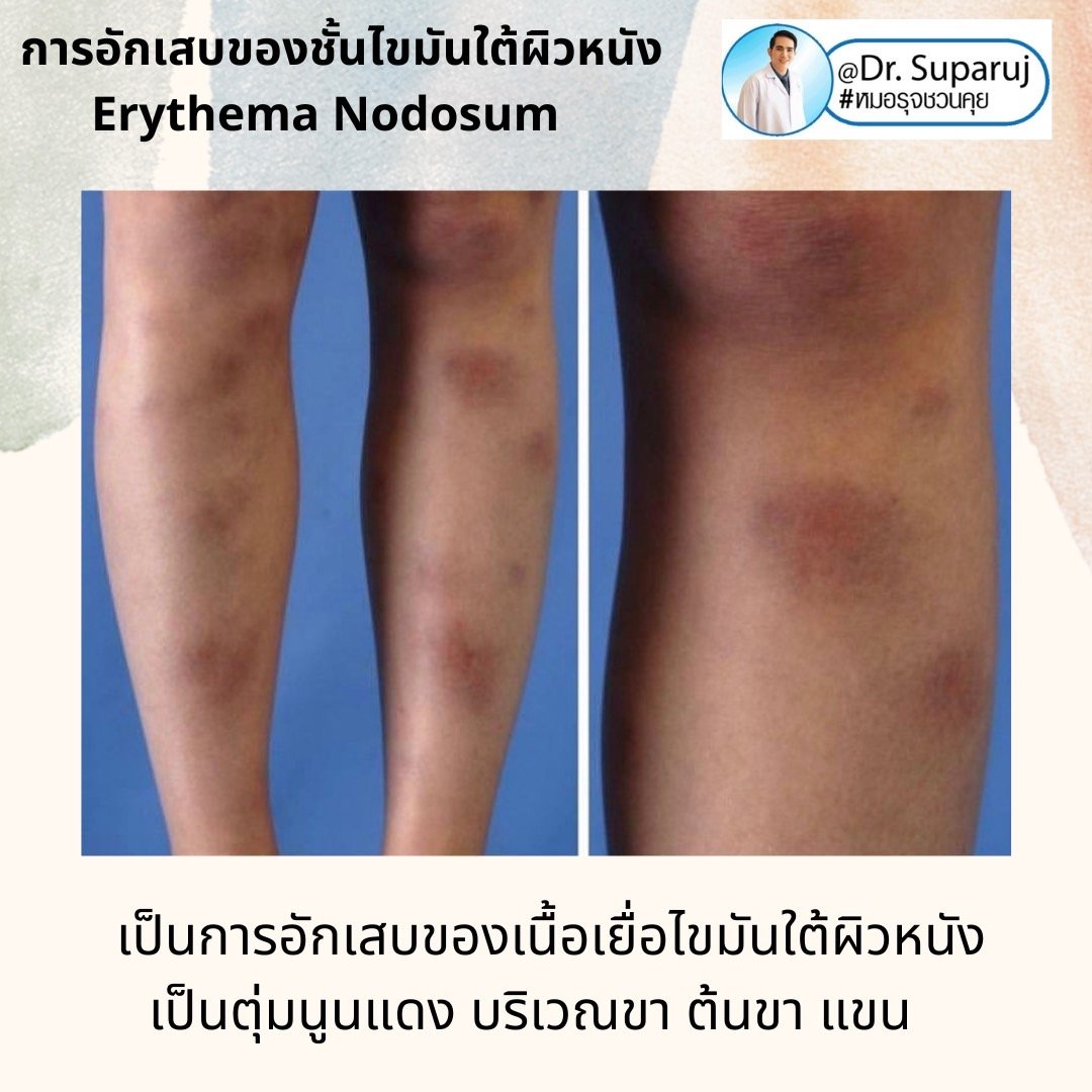 การอักเสบของชั้นไขมันใต้ผิวหนัง Erythema Nodosum คืออะไร ดูแลได้อย่างไร ? การอักเสบของชั้นไขมันใต้ผิวหนัง Erythema Nodosum คืออะไร ดูแลได้อย่างไร ?