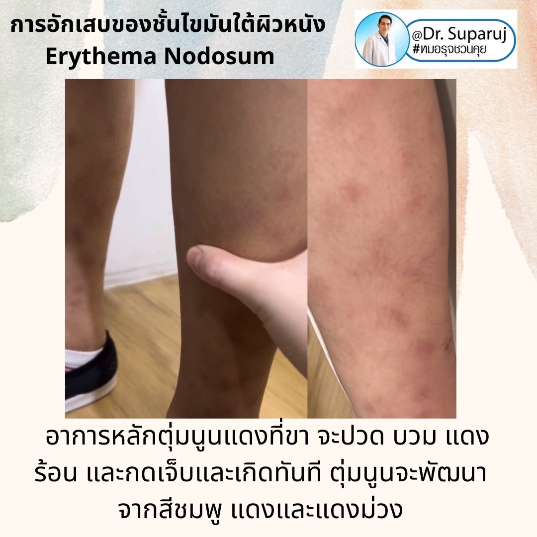 การอักเสบของชั้นไขมันใต้ผิวหนัง Erythema Nodosum คืออะไร ดูแลได้อย่างไร ? การอักเสบของชั้นไขมันใต้ผิวหนัง Erythema Nodosum คืออะไร ดูแลได้อย่างไร ?