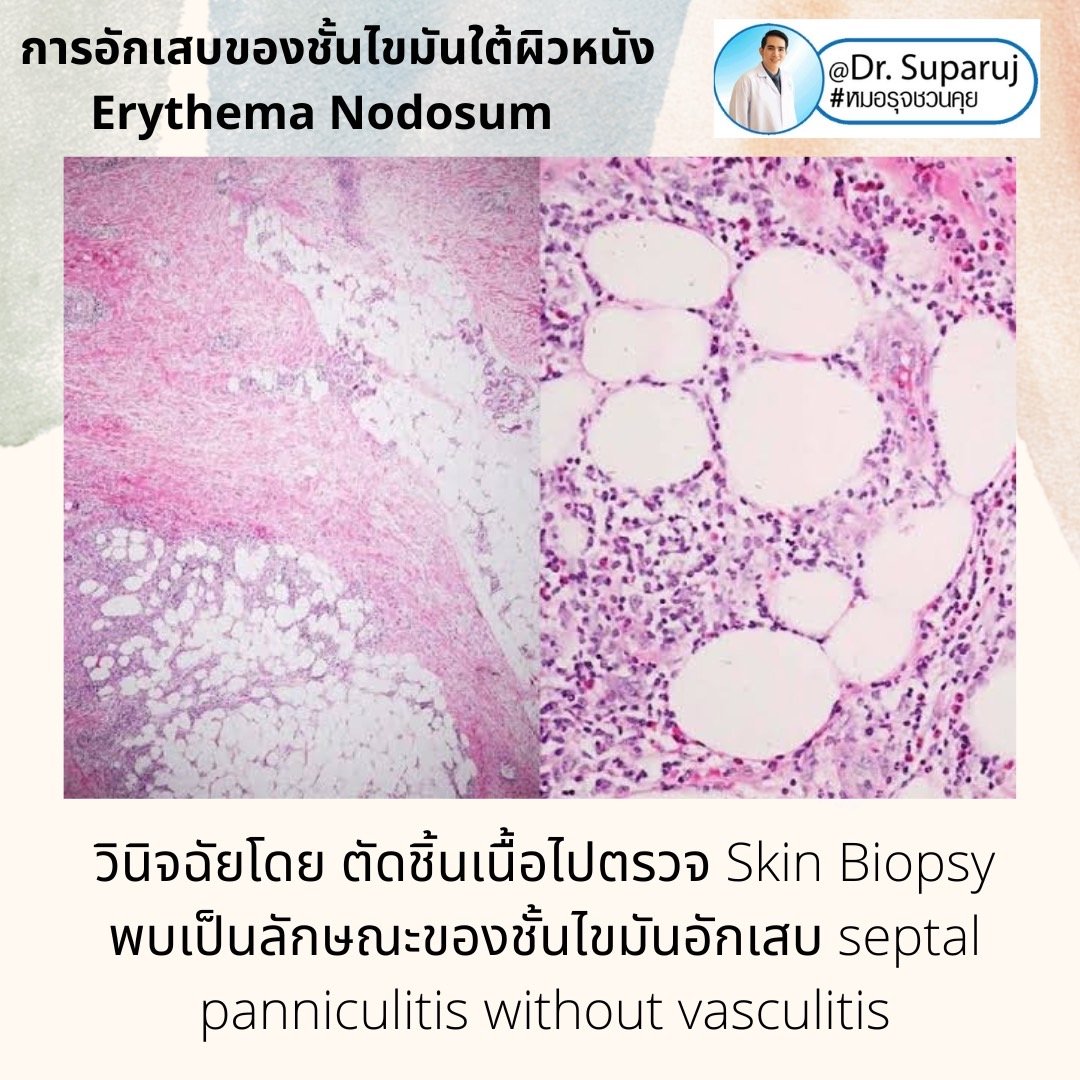 การอักเสบของชั้นไขมันใต้ผิวหนัง Erythema Nodosum คืออะไร ดูแลได้อย่างไร ? การอักเสบของชั้นไขมันใต้ผิวหนัง Erythema Nodosum คืออะไร ดูแลได้อย่างไร ?