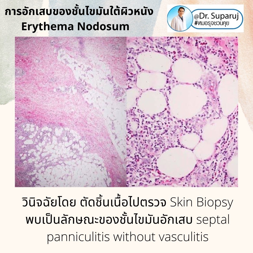 การอักเสบของชั้นไขมันใต้ผิวหนัง Erythema Nodosum คืออะไร ดูแลได้อย่างไร ?