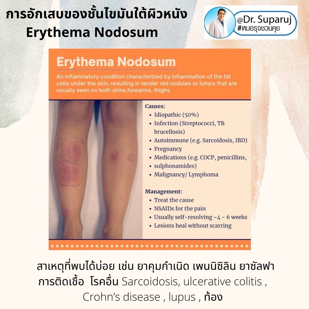 การอักเสบของชั้นไขมันใต้ผิวหนัง Erythema Nodosum คืออะไร ดูแลได้อย่างไร ? การอักเสบของชั้นไขมันใต้ผิวหนัง Erythema Nodosum คืออะไร ดูแลได้อย่างไร ?