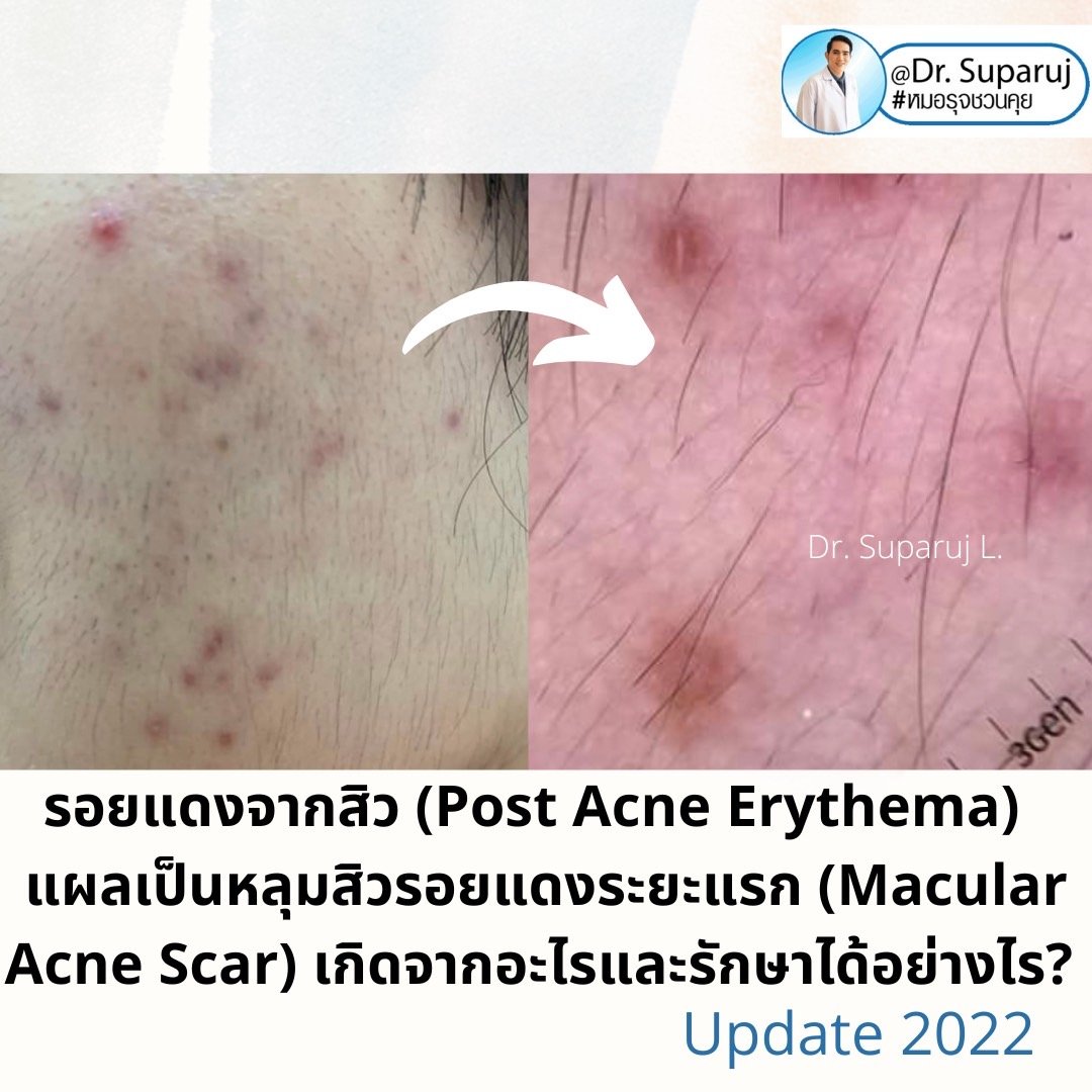 รอยแดงจากสิว (Post Acne Erythema) และ แผลเป็นหลุมสิวรอยแดงระยะแรก (Macular Acne Scar) เกิดจากอะไรและดูแลได้อย่างไร? (Update 2022) รอยแดงจากสิว (Post Acne Erythema) และ แผลเป็นหลุมสิวรอยแดงระยะแรก (Macular Acne Scar) เกิดจากอะไรและดูแลได้อย่างไร? (Update 2022)