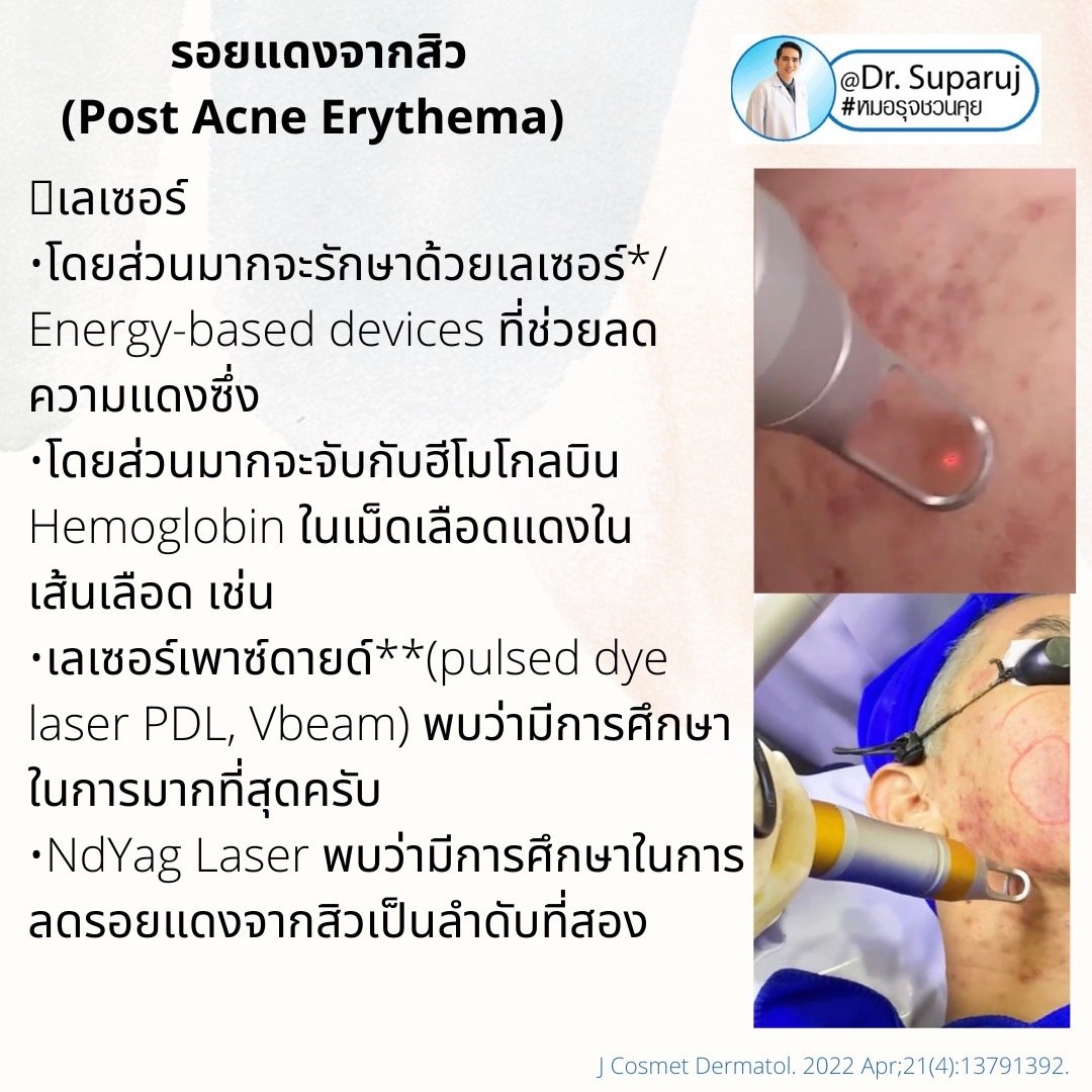 รอยแดงจากสิว (Post Acne Erythema) และ แผลเป็นหลุมสิวรอยแดงระยะแรก (Macular Acne Scar) เกิดจากอะไรและดูแลได้อย่างไร? (Update 2022) รอยแดงจากสิว (Post Acne Erythema) และ แผลเป็นหลุมสิวรอยแดงระยะแรก (Macular Acne Scar) เกิดจากอะไรและดูแลได้อย่างไร? (Update 2022)