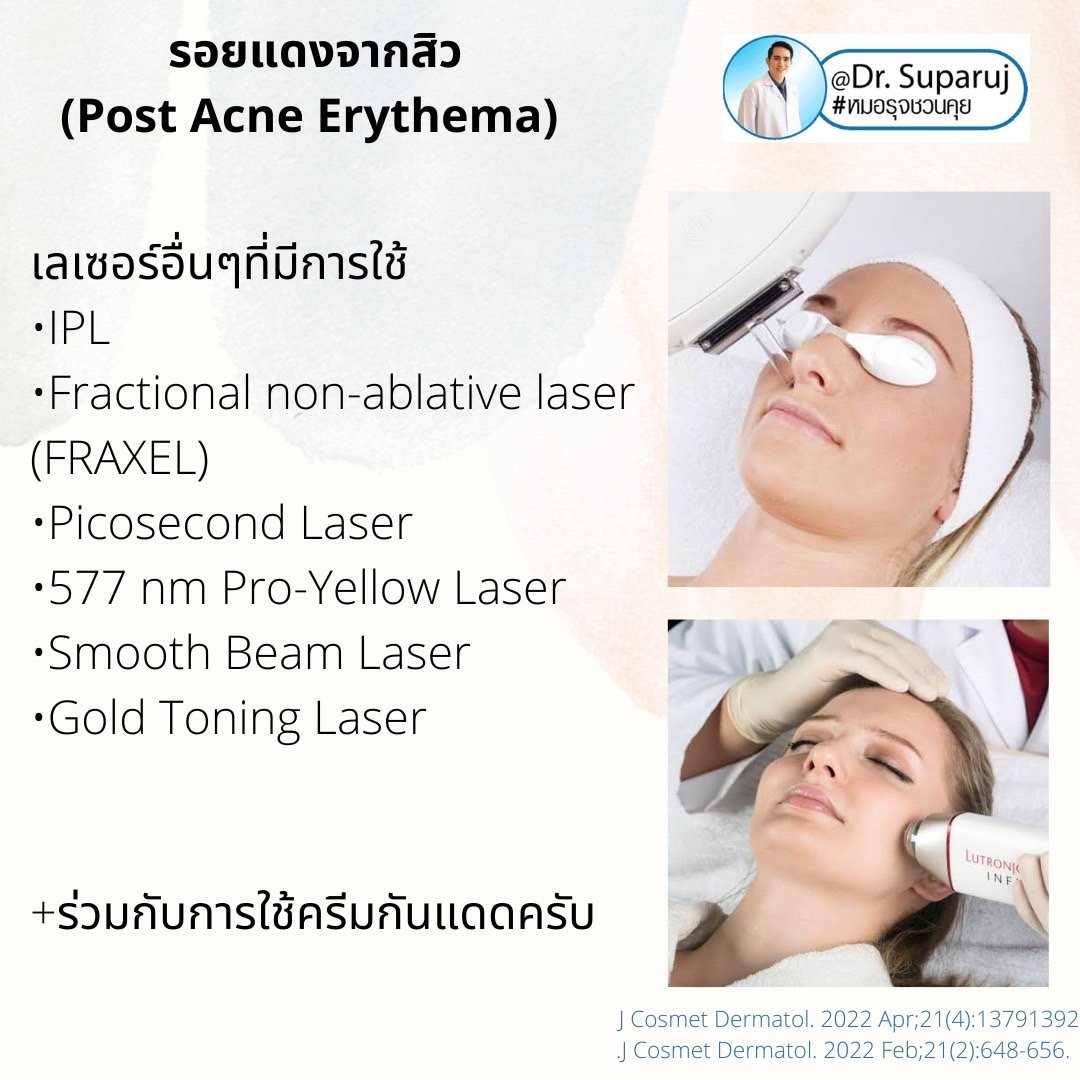 รอยแดงจากสิว (Post Acne Erythema) และ แผลเป็นหลุมสิวรอยแดงระยะแรก (Macular Acne Scar) เกิดจากอะไรและดูแลได้อย่างไร? (Update 2022) รอยแดงจากสิว (Post Acne Erythema) และ แผลเป็นหลุมสิวรอยแดงระยะแรก (Macular Acne Scar) เกิดจากอะไรและดูแลได้อย่างไร? (Update 2022)