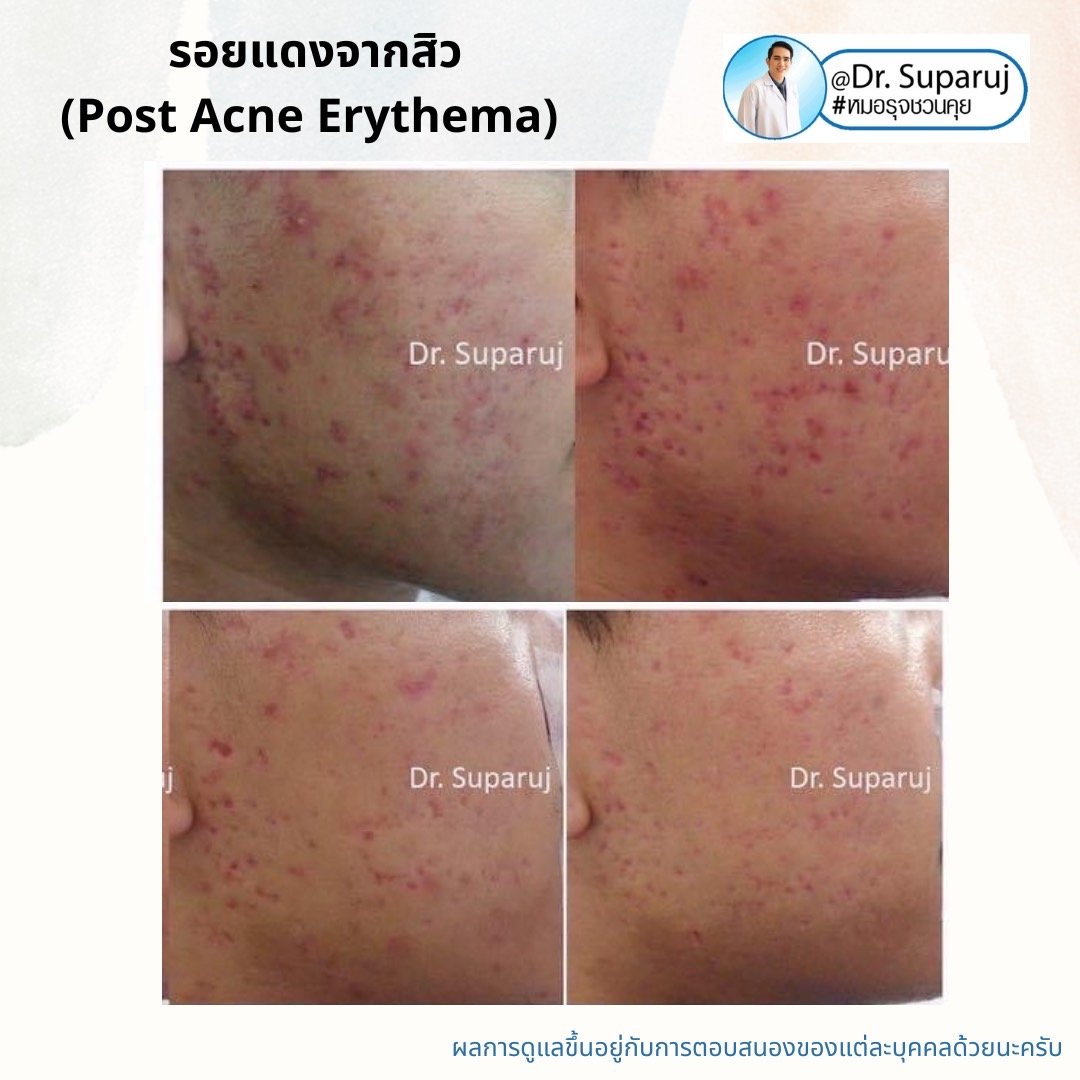 รอยแดงจากสิว (Post Acne Erythema) และ แผลเป็นหลุมสิวรอยแดงระยะแรก (Macular Acne Scar) เกิดจากอะไรและดูแลได้อย่างไร? (Update 2022) รอยแดงจากสิว (Post Acne Erythema) และ แผลเป็นหลุมสิวรอยแดงระยะแรก (Macular Acne Scar) เกิดจากอะไรและดูแลได้อย่างไร? (Update 2022)