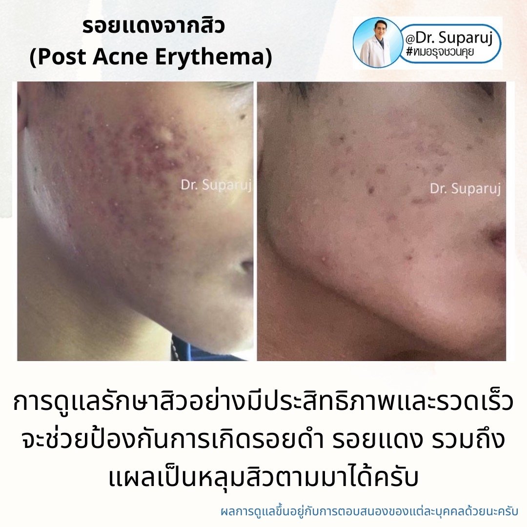 รอยแดงจากสิว (Post Acne Erythema) และ แผลเป็นหลุมสิวรอยแดงระยะแรก (Macular Acne Scar) เกิดจากอะไรและดูแลได้อย่างไร? (Update 2022)