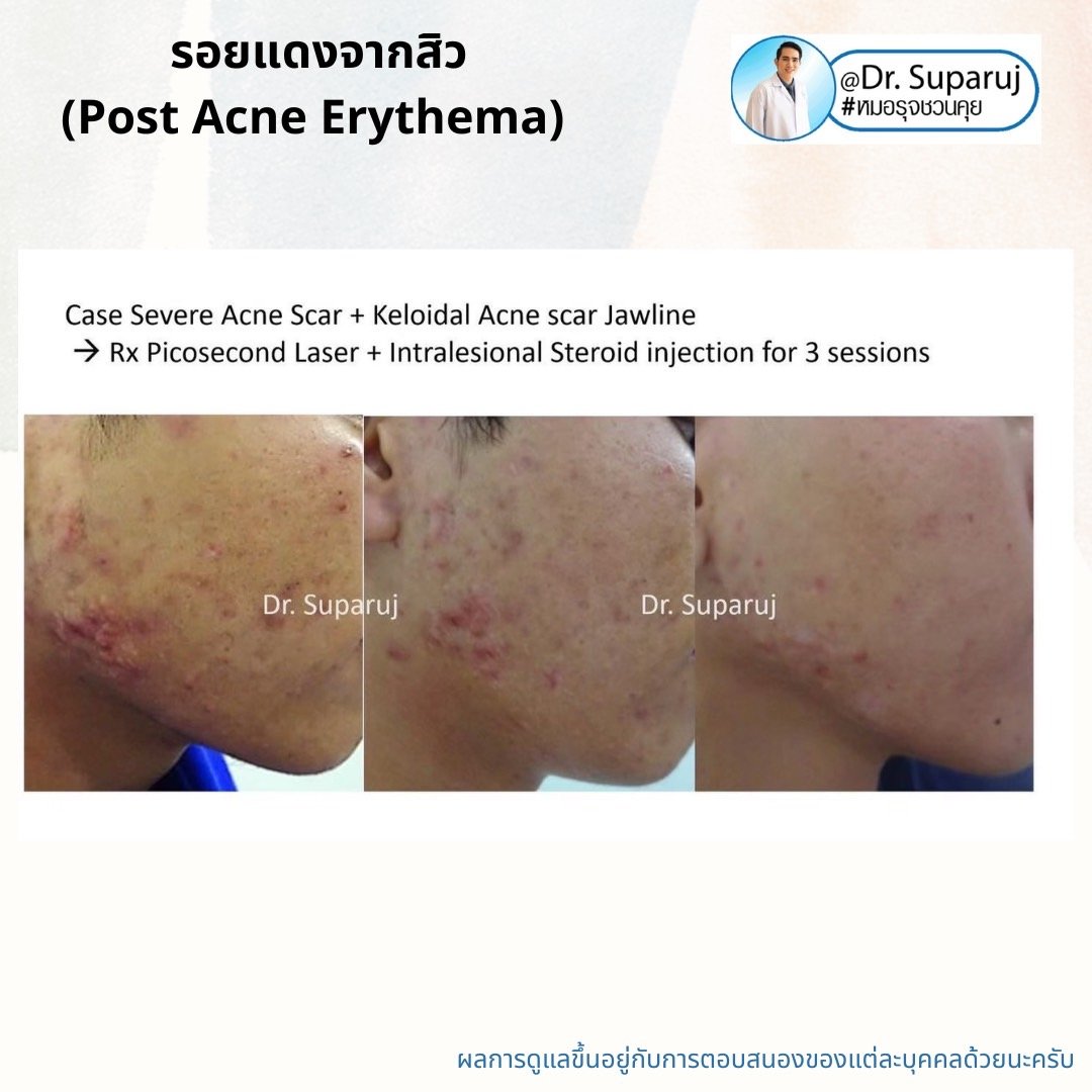 รอยแดงจากสิว (Post Acne Erythema) และ แผลเป็นหลุมสิวรอยแดงระยะแรก (Macular Acne Scar) เกิดจากอะไรและดูแลได้อย่างไร? (Update 2022)