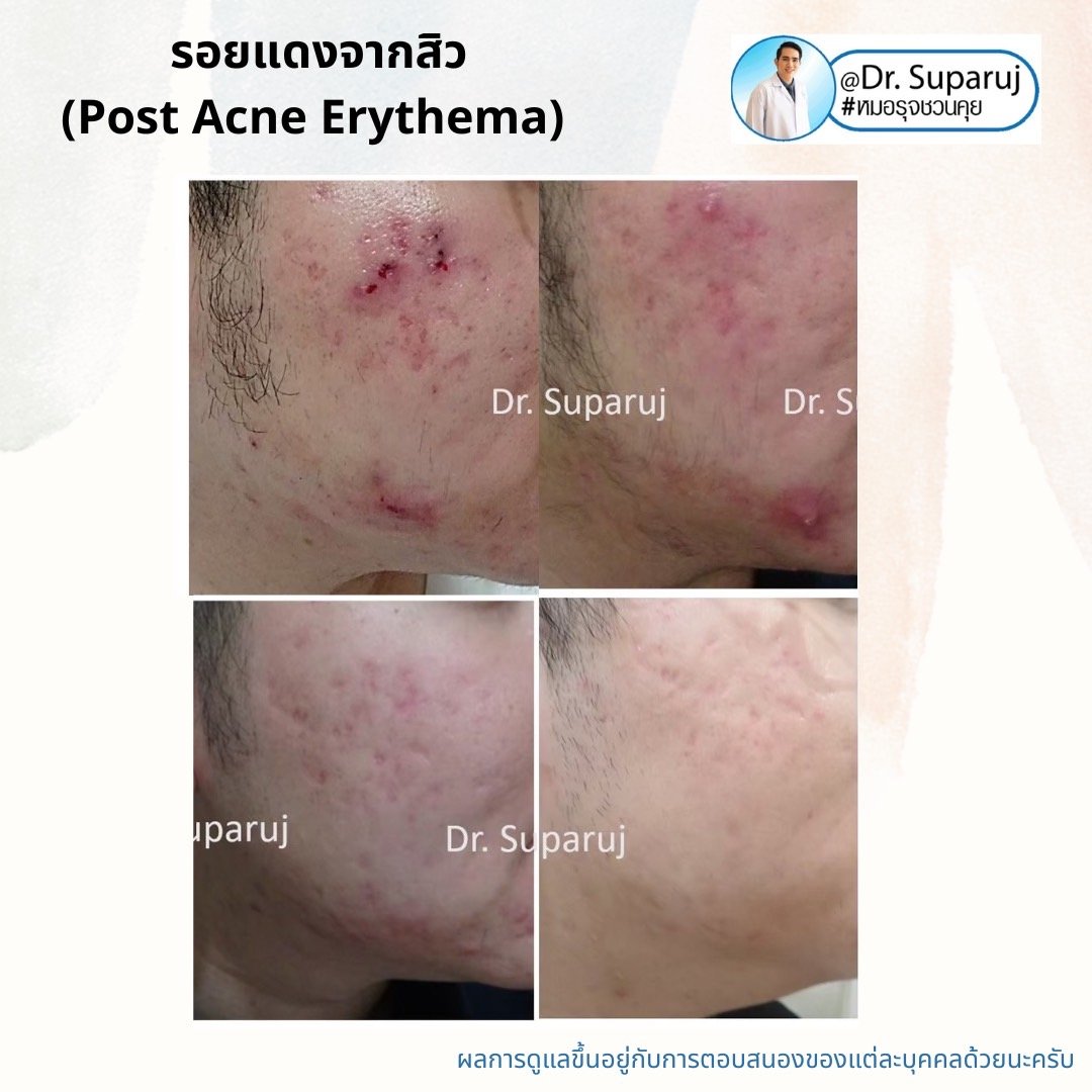 รอยแดงจากสิว (Post Acne Erythema) และ แผลเป็นหลุมสิวรอยแดงระยะแรก (Macular Acne Scar) เกิดจากอะไรและดูแลได้อย่างไร? (Update 2022) รอยแดงจากสิว (Post Acne Erythema) และ แผลเป็นหลุมสิวรอยแดงระยะแรก (Macular Acne Scar) เกิดจากอะไรและดูแลได้อย่างไร? (Update 2022)