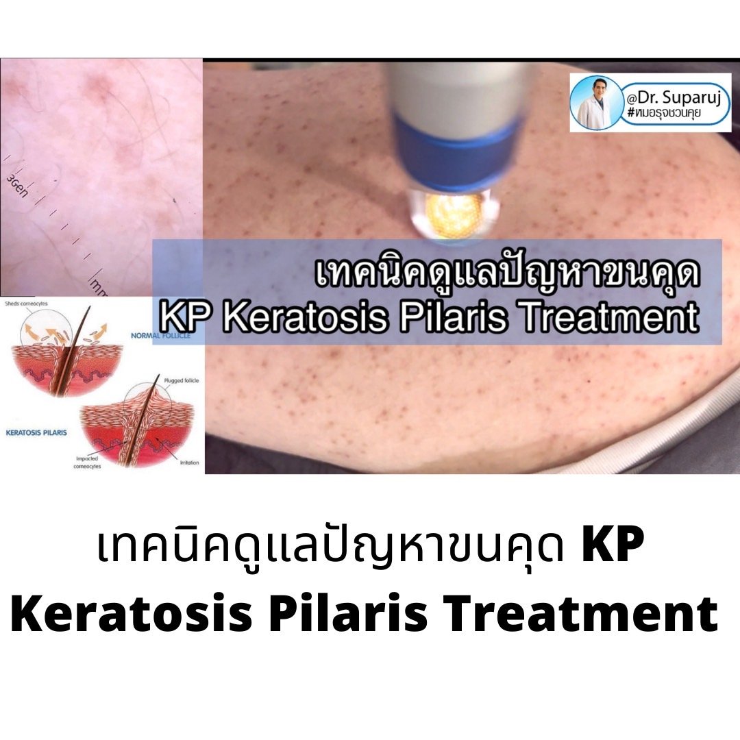 เทคนิคดูแลปัญหาขนคุด KP Keratosis Pilaris Treatment ขนคุด (Keratosis Pilaris) หรือเรียนอีกชื่อว่า “ผิวหนังไก่” เทคนิคดูแลปัญหาขนคุด KP Keratosis Pilaris Treatment ขนคุด (Keratosis Pilaris) หรือเรียนอีกชื่อว่า “ผิวหนังไก่”