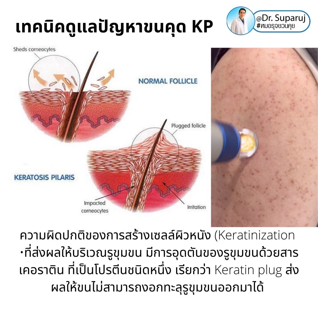 เทคนิคดูแลปัญหาขนคุด KP Keratosis Pilaris Treatment ขนคุด (Keratosis Pilaris) หรือเรียนอีกชื่อว่า “ผิวหนังไก่” เทคนิคดูแลปัญหาขนคุด KP Keratosis Pilaris Treatment ขนคุด (Keratosis Pilaris) หรือเรียนอีกชื่อว่า “ผิวหนังไก่”