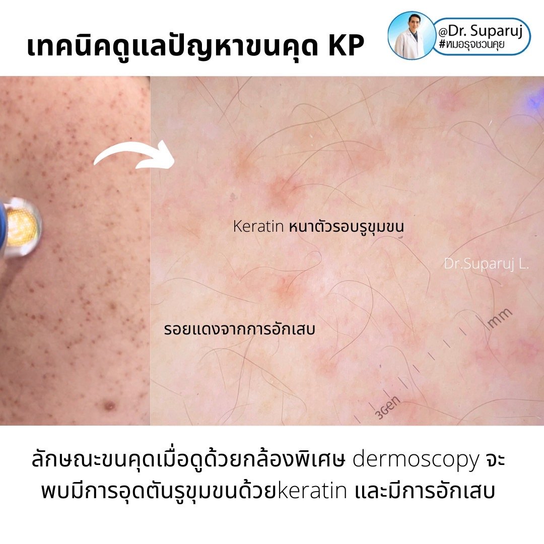 เทคนิคดูแลปัญหาขนคุด KP Keratosis Pilaris Treatment ขนคุด (Keratosis Pilaris) หรือเรียนอีกชื่อว่า “ผิวหนังไก่” เทคนิคดูแลปัญหาขนคุด KP Keratosis Pilaris Treatment ขนคุด (Keratosis Pilaris) หรือเรียนอีกชื่อว่า “ผิวหนังไก่”