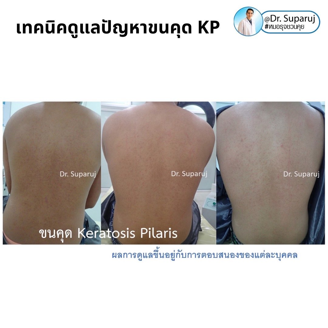 เทคนิคดูแลปัญหาขนคุด KP Keratosis Pilaris Treatment ขนคุด (Keratosis Pilaris) หรือเรียนอีกชื่อว่า “ผิวหนังไก่”