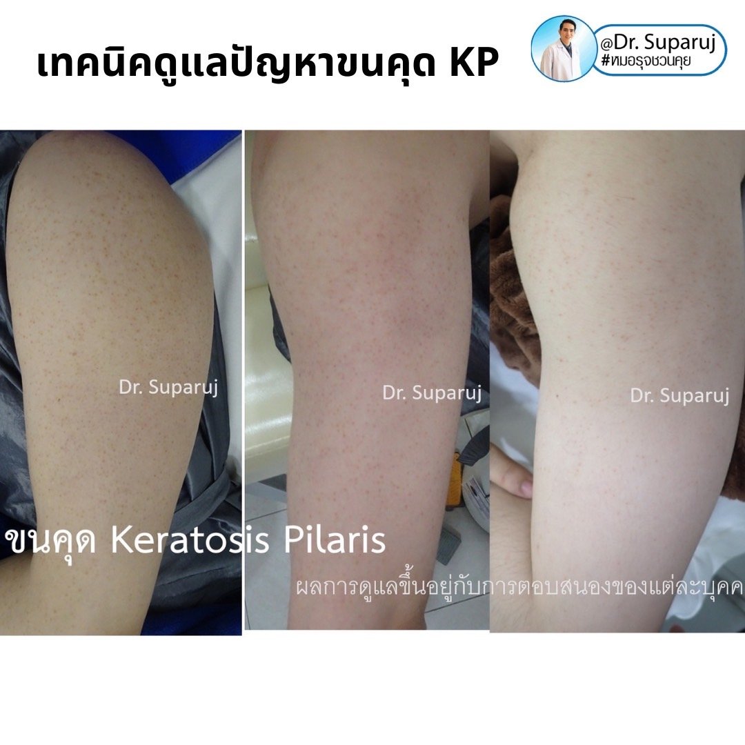 เทคนิคดูแลปัญหาขนคุด KP Keratosis Pilaris Treatment ขนคุด (Keratosis Pilaris) หรือเรียนอีกชื่อว่า “ผิวหนังไก่” เทคนิคดูแลปัญหาขนคุด KP Keratosis Pilaris Treatment ขนคุด (Keratosis Pilaris) หรือเรียนอีกชื่อว่า “ผิวหนังไก่”