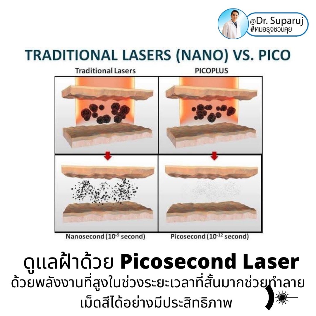 Update เทคนิครักษาฝ้า Melasma Treatment Update เทคนิครักษาฝ้า Melasma Treatment