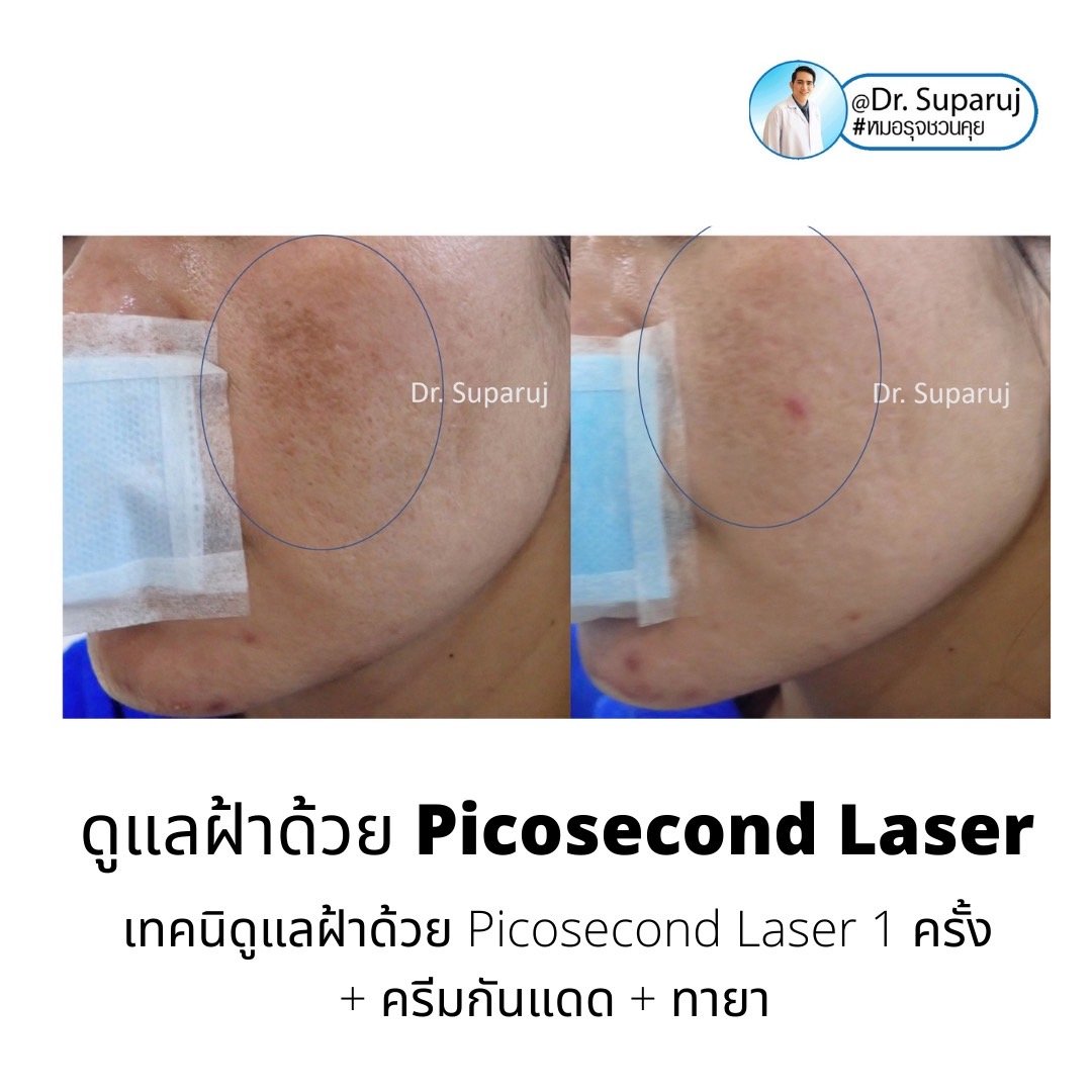 Update เทคนิครักษาฝ้า Melasma Treatment Update เทคนิครักษาฝ้า Melasma Treatment