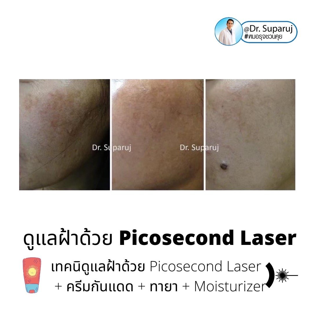 Update เทคนิครักษาฝ้า Melasma Treatment Update เทคนิครักษาฝ้า Melasma Treatment