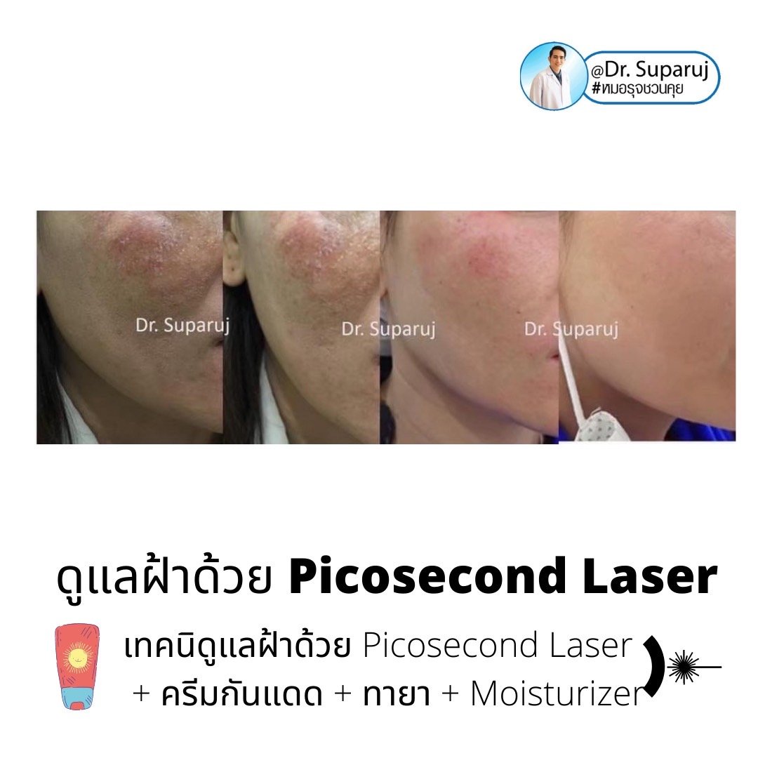 Update เทคนิครักษาฝ้า Melasma Treatment Update เทคนิครักษาฝ้า Melasma Treatment