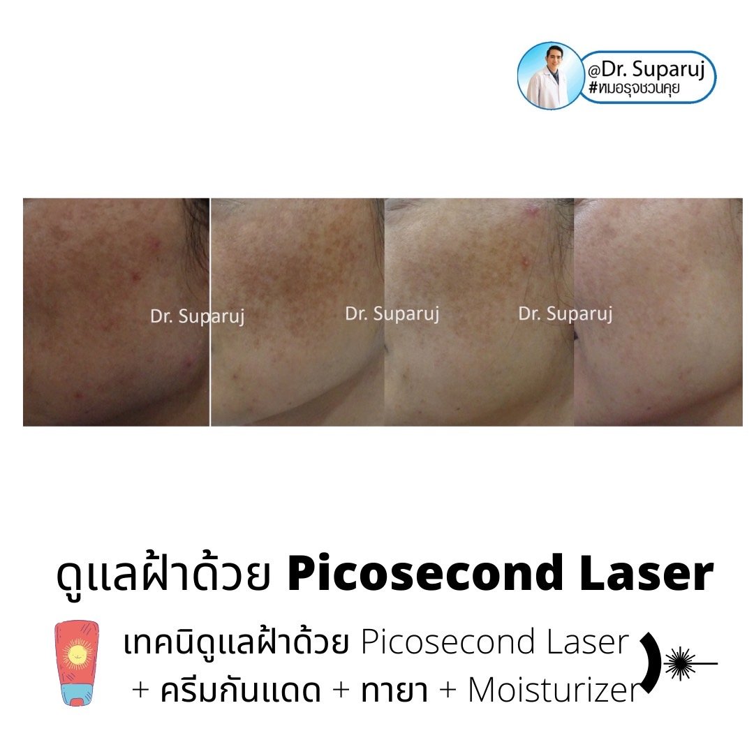 Update เทคนิครักษาฝ้า Melasma Treatment