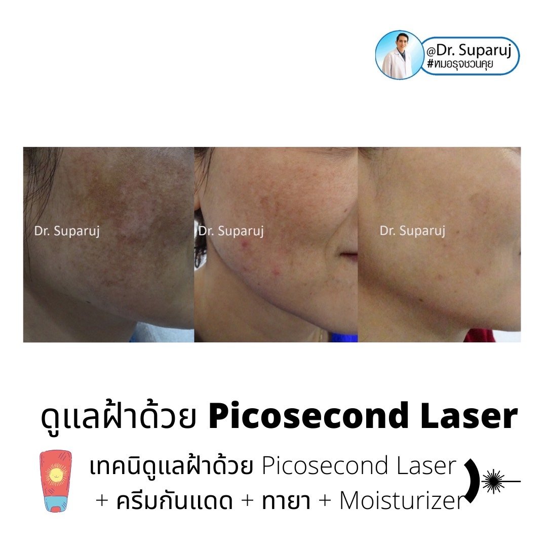 Update เทคนิครักษาฝ้า Melasma Treatment Update เทคนิครักษาฝ้า Melasma Treatment