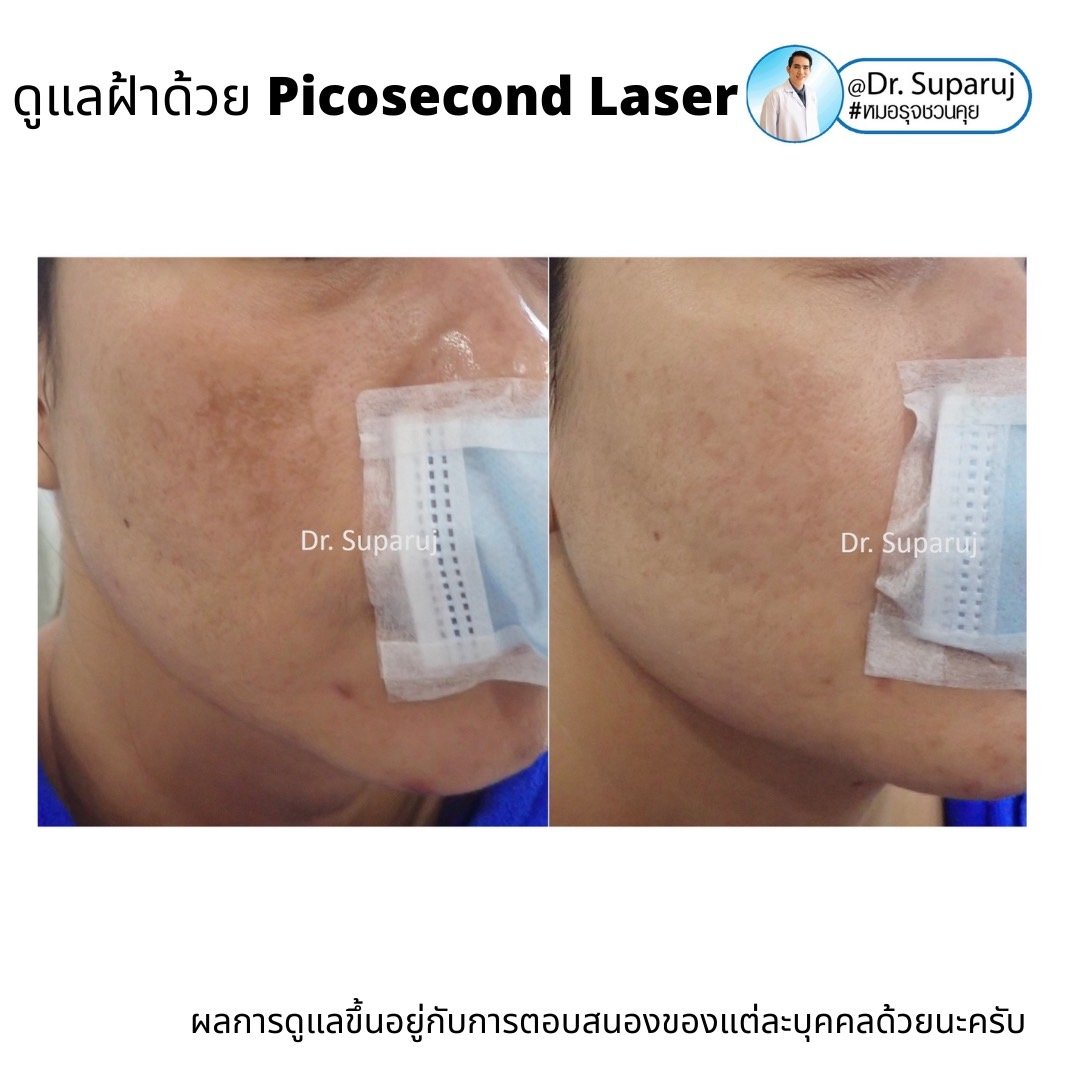 Update เทคนิครักษาฝ้า Melasma Treatment Update เทคนิครักษาฝ้า Melasma Treatment