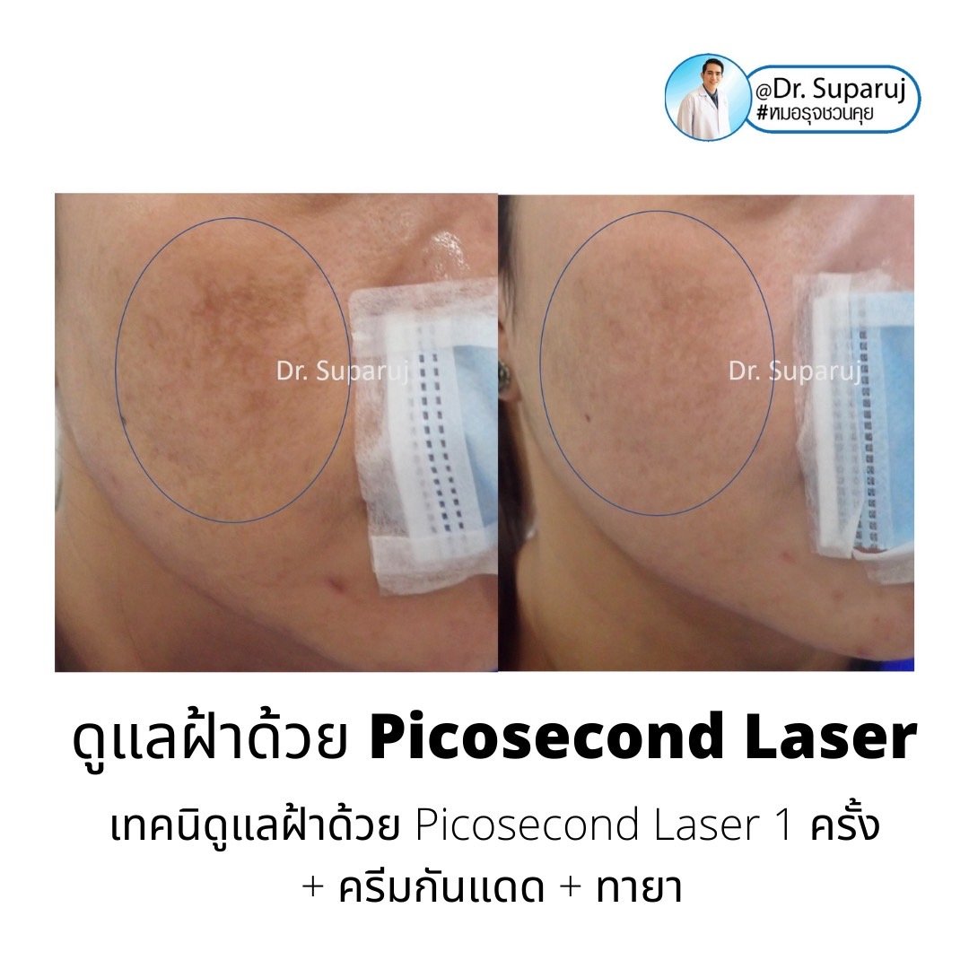 Update เทคนิครักษาฝ้า Melasma Treatment Update เทคนิครักษาฝ้า Melasma Treatment