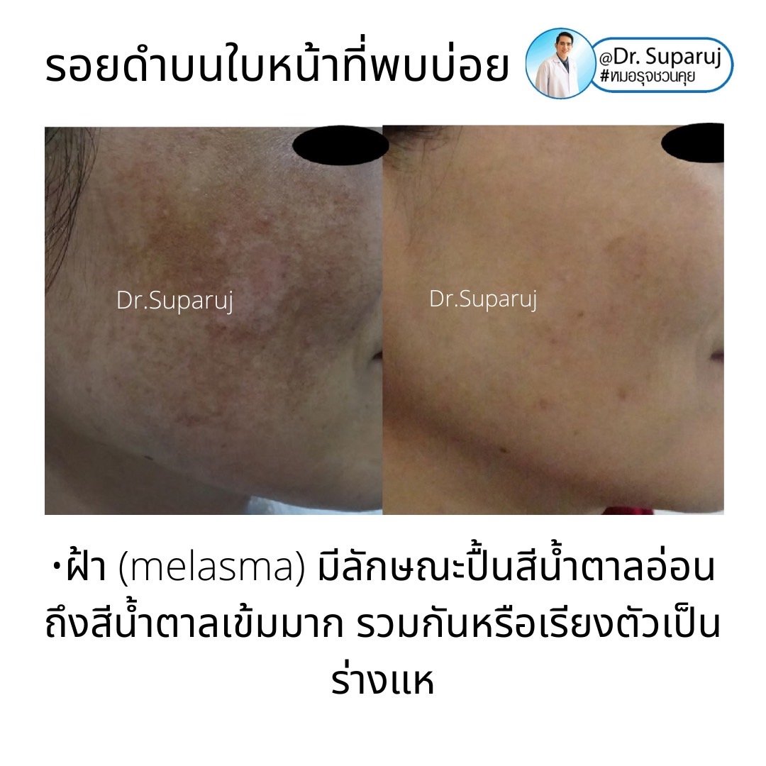 กระตื้น Freckle มีลักษณะอย่างไรดูแลได้อย่างไรบ้าง?