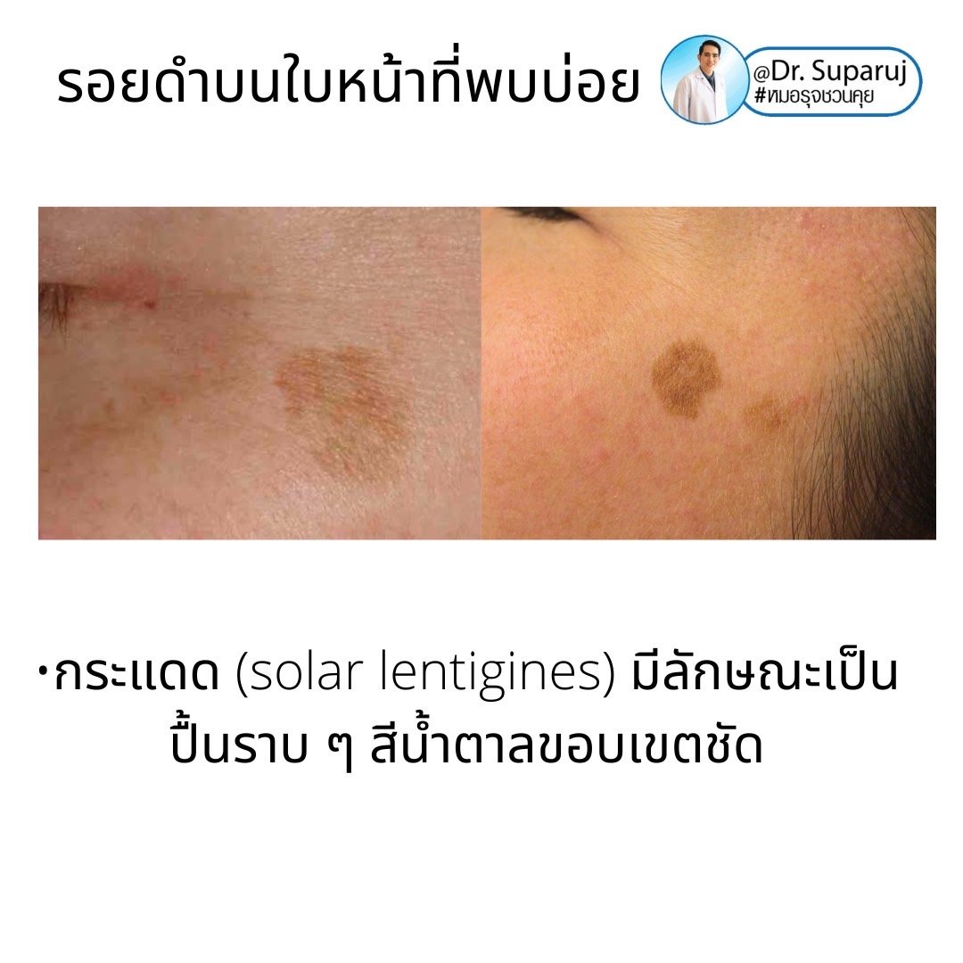 กระตื้น Freckle มีลักษณะอย่างไรดูแลได้อย่างไรบ้าง?