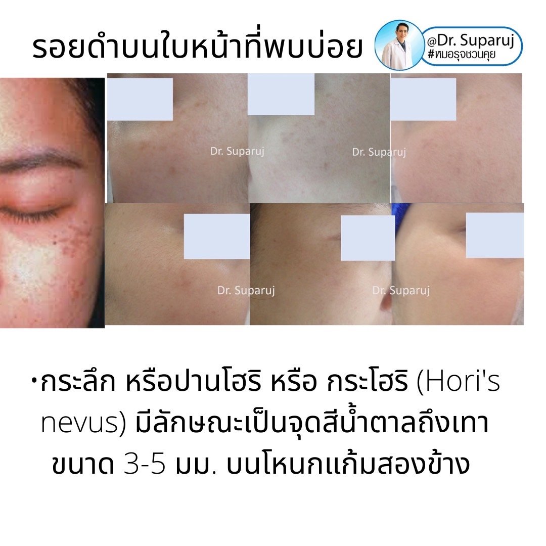 กระตื้น Freckle มีลักษณะอย่างไรดูแลได้อย่างไรบ้าง?