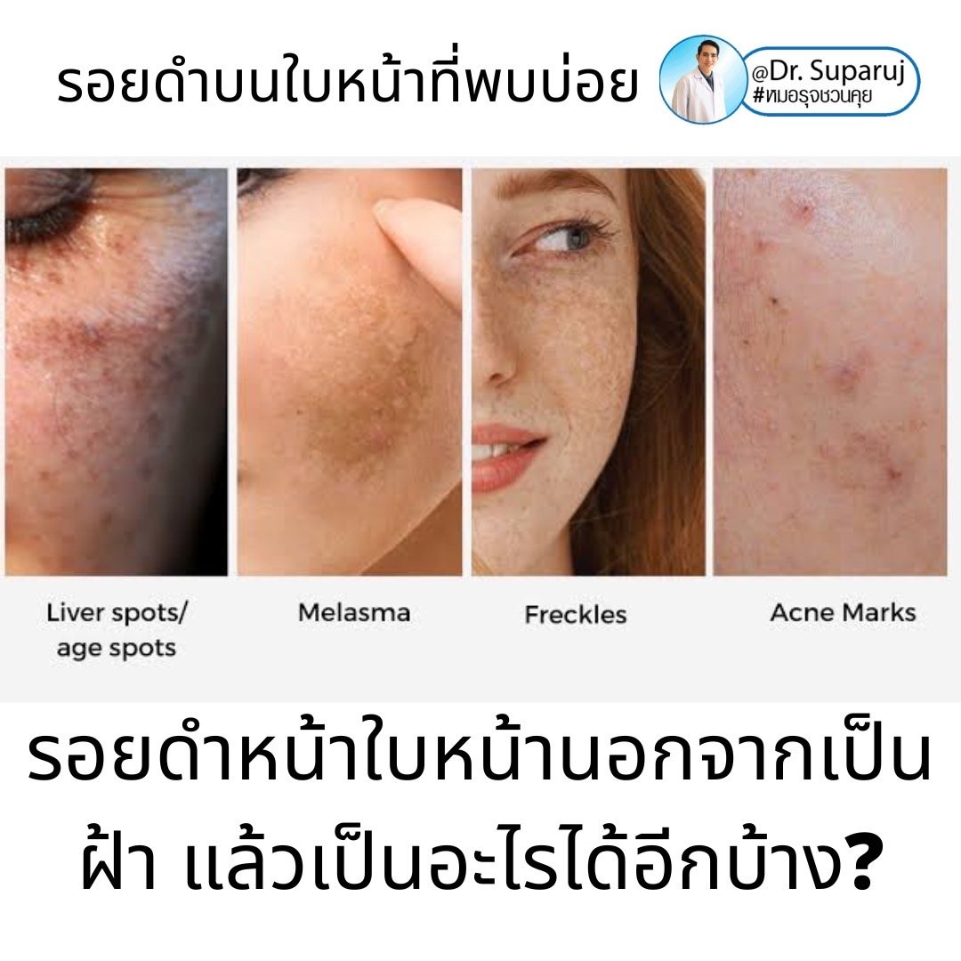 กระตื้น Freckle มีลักษณะอย่างไรดูแลได้อย่างไรบ้าง? กระตื้น Freckle มีลักษณะอย่างไรดูแลได้อย่างไรบ้าง?
