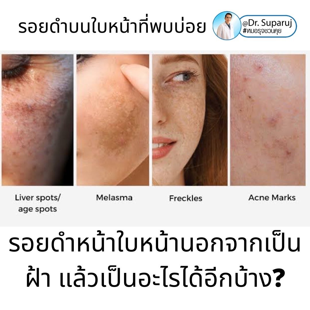 กระตื้น Freckle มีลักษณะอย่างไรดูแลได้อย่างไรบ้าง?