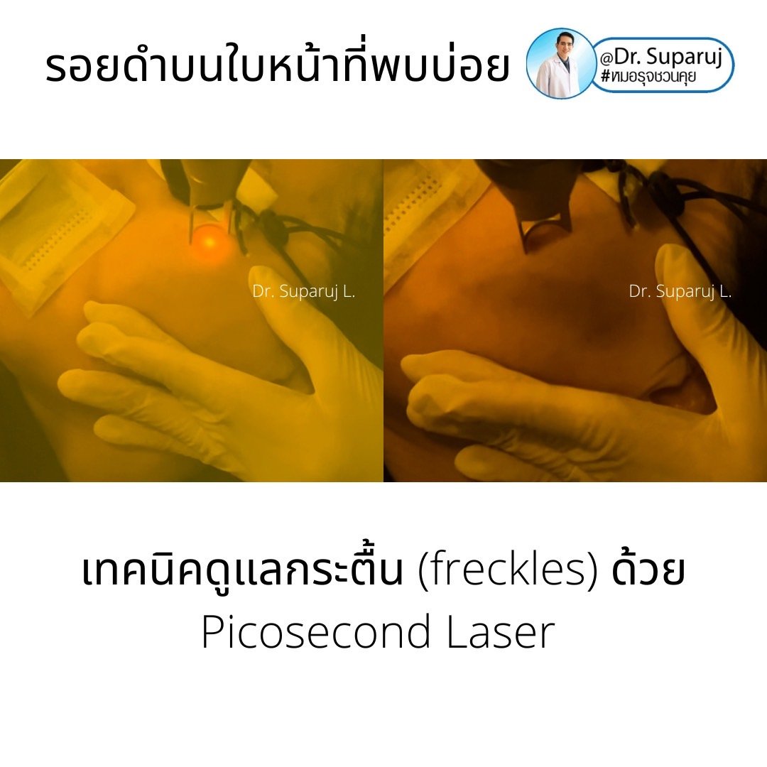 กระตื้น Freckle มีลักษณะอย่างไรดูแลได้อย่างไรบ้าง?