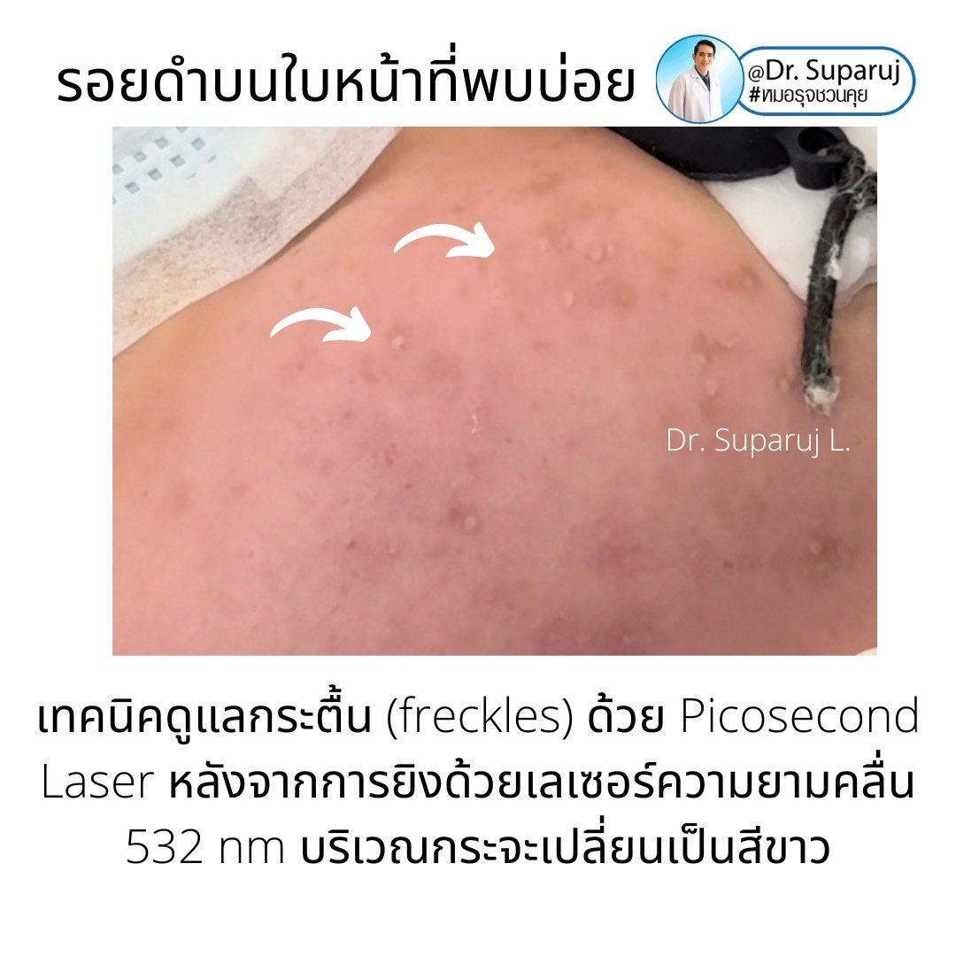 กระตื้น Freckle มีลักษณะอย่างไรดูแลได้อย่างไรบ้าง?