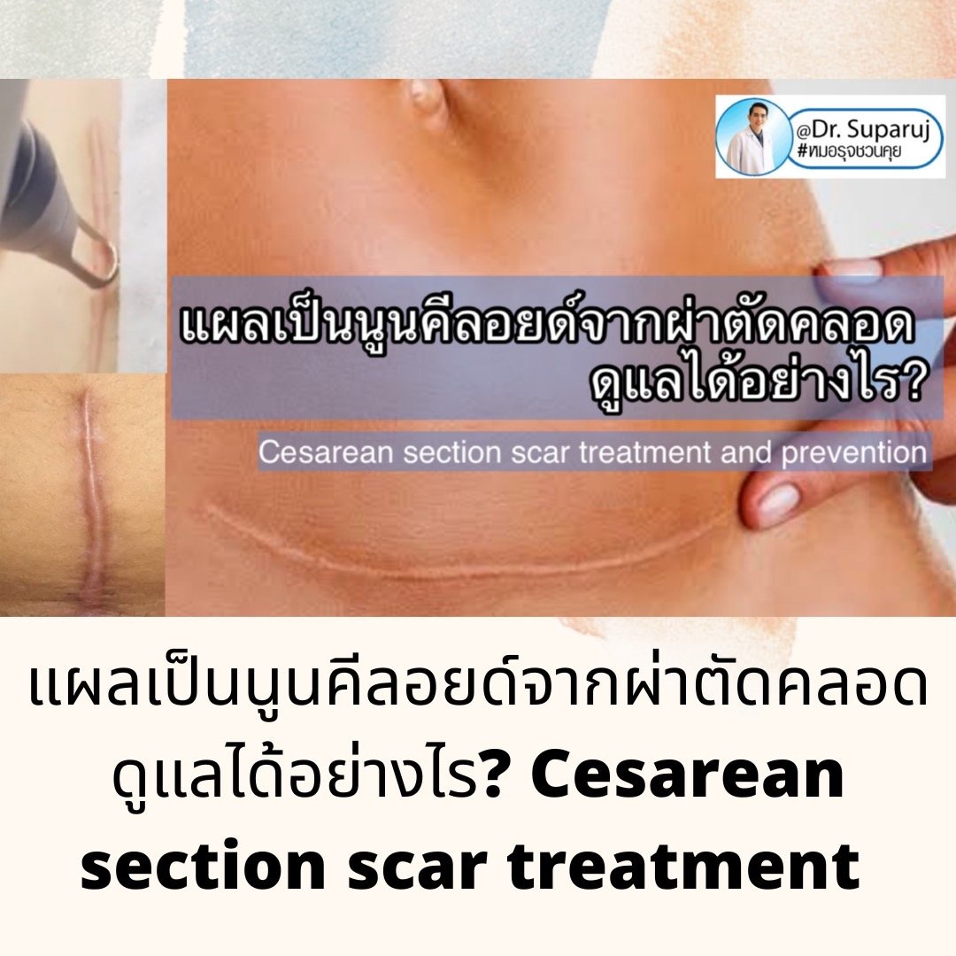 เทคนิคดูแลรักษาแผลเป็นนูนคีลอยด์จากผ่าตัดคลอด Cesarean section scar treatment and prevention เทคนิคดูแลรักษาแผลเป็นนูนคีลอยด์จากผ่าตัดคลอด Cesarean section scar treatment and prevention