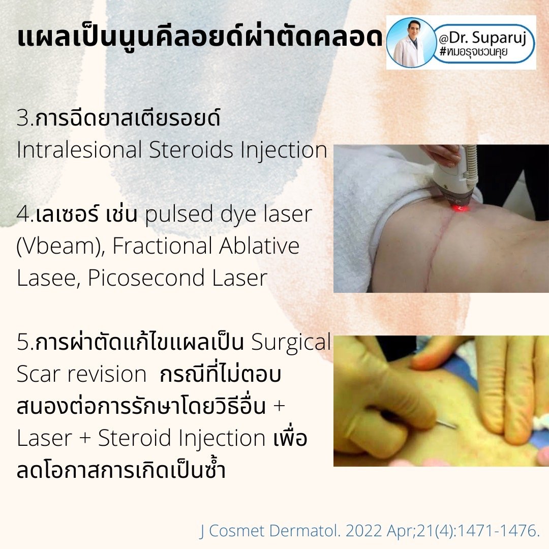 เทคนิคดูแลรักษาแผลเป็นนูนคีลอยด์จากผ่าตัดคลอด Cesarean section scar treatment and prevention เทคนิคดูแลรักษาแผลเป็นนูนคีลอยด์จากผ่าตัดคลอด Cesarean section scar treatment and prevention