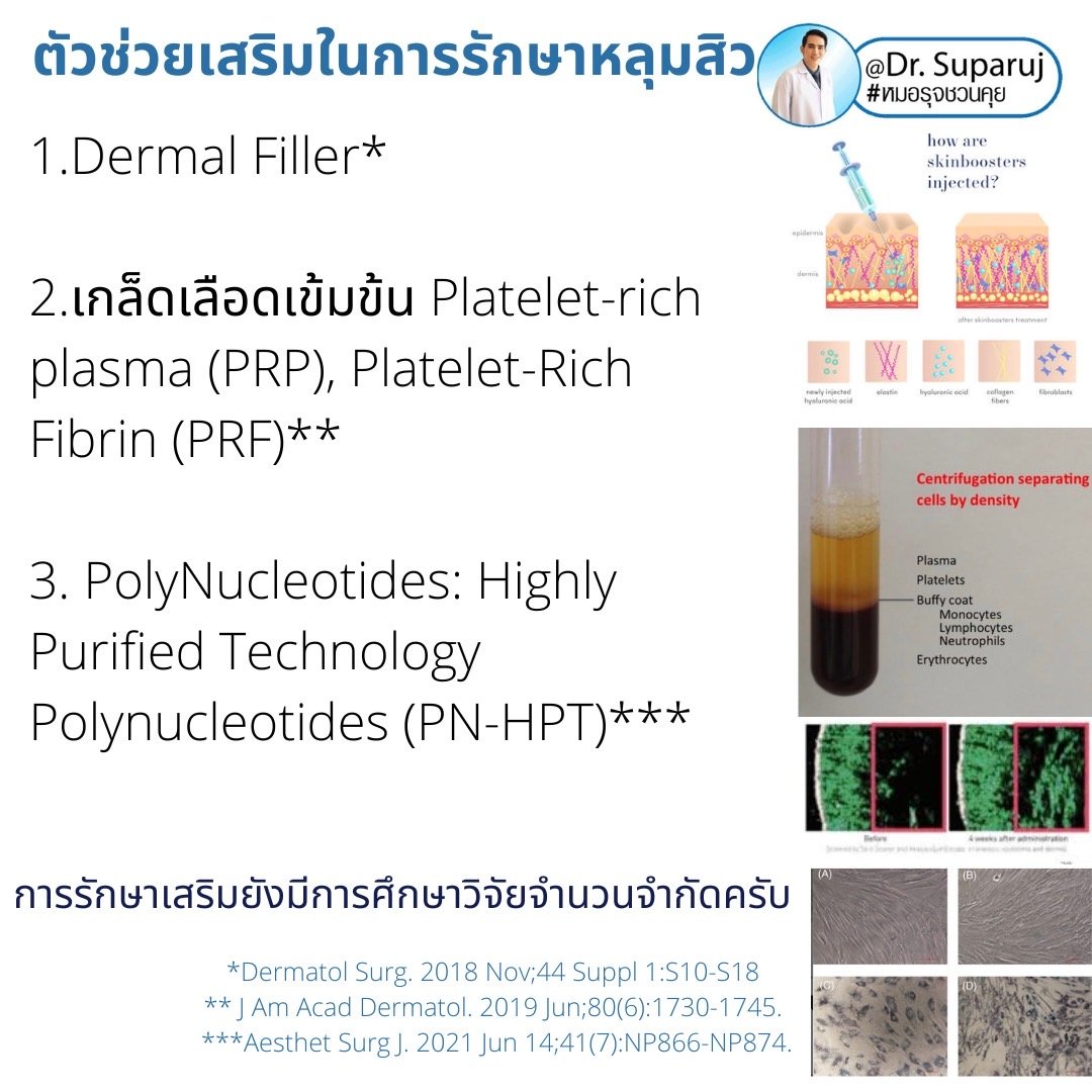 Update ตัวช่วยเสริมในการรักษาหลุมสิว มีอะไรบ้าง? Update ตัวช่วยเสริมในการรักษาหลุมสิว มีอะไรบ้าง?