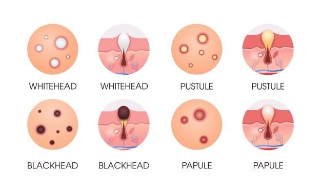 ดูแลแผลเป็นจากสิว Acne Scar ได้อย่างไรบ้าง ดูแลแผลเป็นจากสิว Acne Scar ได้อย่างไรบ้าง