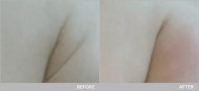 Ultraformer III Body นวัตกรรมสลายไขมันด้วย MMFU กระชับสัดส่วน โดยไม่ต้องผ่าตัด ไม่ต้องพักฟื้น Ultraformer III Body นวัตกรรมสลายไขมันด้วย MMFU กระชับสัดส่วน โดยไม่ต้องผ่าตัด ไม่ต้องพักฟื้น