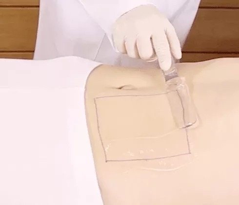 Ultraformer III Body นวัตกรรมสลายไขมันด้วย MMFU กระชับสัดส่วน โดยไม่ต้องผ่าตัด ไม่ต้องพักฟื้น Ultraformer III Body นวัตกรรมสลายไขมันด้วย MMFU กระชับสัดส่วน โดยไม่ต้องผ่าตัด ไม่ต้องพักฟื้น