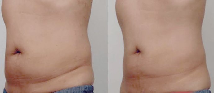 Ultraformer III Body นวัตกรรมสลายไขมันด้วย MMFU กระชับสัดส่วน โดยไม่ต้องผ่าตัด ไม่ต้องพักฟื้น Ultraformer III Body นวัตกรรมสลายไขมันด้วย MMFU กระชับสัดส่วน โดยไม่ต้องผ่าตัด ไม่ต้องพักฟื้น