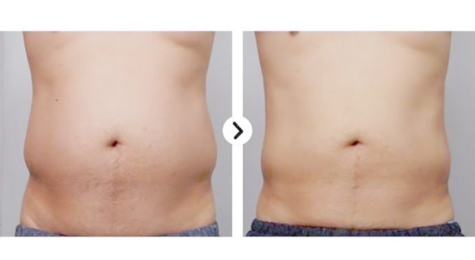 Ultraformer III Body นวัตกรรมสลายไขมันด้วย MMFU กระชับสัดส่วน โดยไม่ต้องผ่าตัด ไม่ต้องพักฟื้น Ultraformer III Body นวัตกรรมสลายไขมันด้วย MMFU กระชับสัดส่วน โดยไม่ต้องผ่าตัด ไม่ต้องพักฟื้น