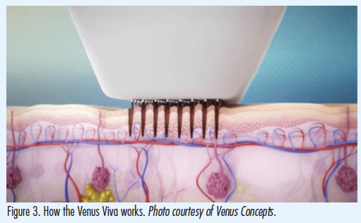 ขอบคุณภาพประกอบจาก :  https://www.the-dermatologist.com/