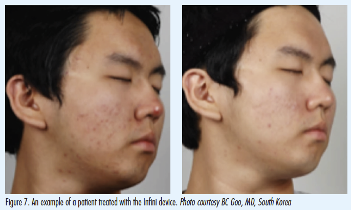 ขอบคุณภาพประกอบจาก :  https://www.the-dermatologist.com/