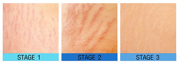 ผิวแตกลาย หรือ รอยแตกลาย (Stretch Mark หรือ Striae) ดูแลได้อย่างไร ? ผิวแตกลาย หรือ รอยแตกลาย (Stretch Mark หรือ Striae) ดูแลได้อย่างไร ?