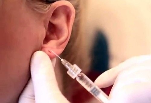 แนะนำเทคนิคดูแลแผลเป็นนูนคีลอยด์ Ep. 3 คีลอยด์ใบหู? Ear Keloid ดูแลได้อย่างไร? แนะนำเทคนิคดูแลแผลเป็นนูนคีลอยด์ Ep. 3 คีลอยด์ใบหู? Ear Keloid ดูแลได้อย่างไร?