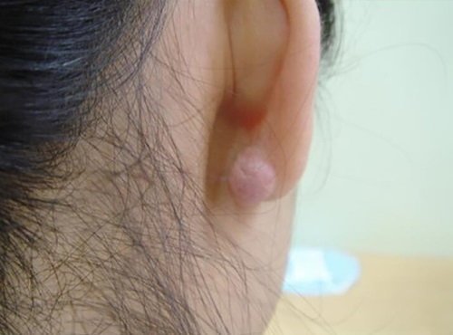 แนะนำเทคนิคดูแลแผลเป็นนูนคีลอยด์ Ep. 3 คีลอยด์ใบหู? Ear Keloid ดูแลได้อย่างไร?