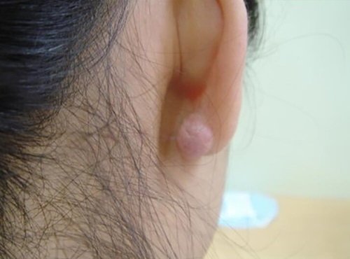 แนะนำเทคนิคดูแลแผลเป็นนูนคีลอยด์ Ep. 3 คีลอยด์ใบหู? Ear Keloid ดูแลได้อย่างไร? แนะนำเทคนิคดูแลแผลเป็นนูนคีลอยด์ Ep. 3 คีลอยด์ใบหู? Ear Keloid ดูแลได้อย่างไร?